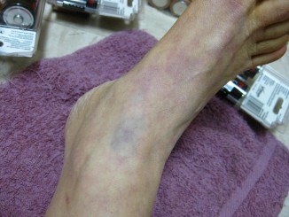 Bruises from locked leather retraint cuffs on for many hours, immobilizing me