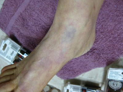 Ankle swollen and discolored from hours in 4-point punitive restraints the night before discharge/escape