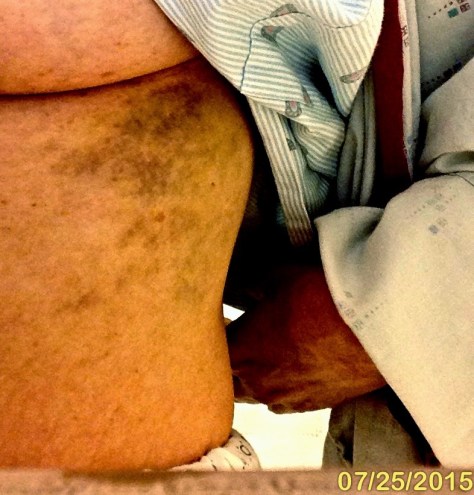 Ribcage bruise a week later